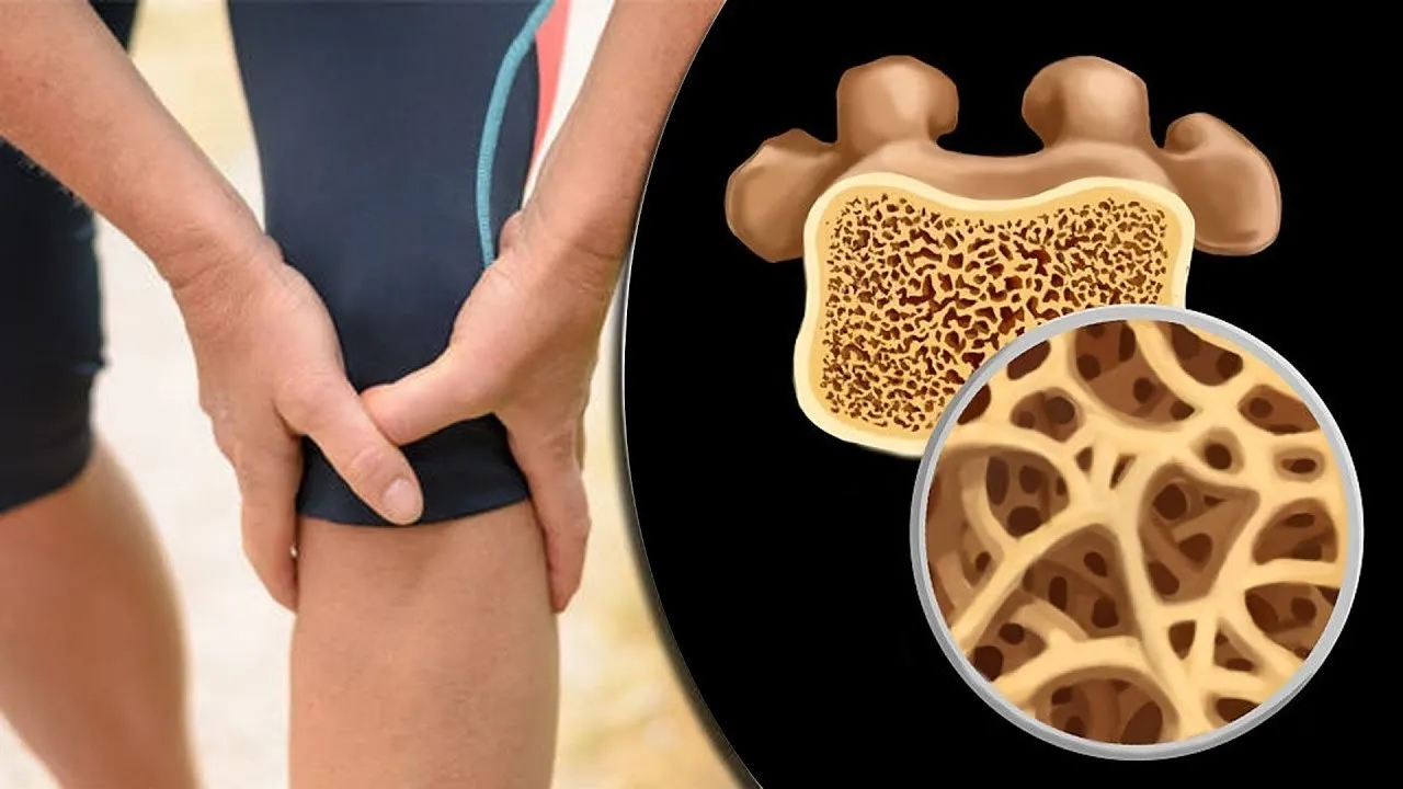 أسباب هشاشة العظام وعوامل الخطر - شركة الطب المتميز للخدمات الطبيه