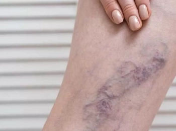 أفضل دكتور أشعة دوبلر لتشخيص جلطة الساق