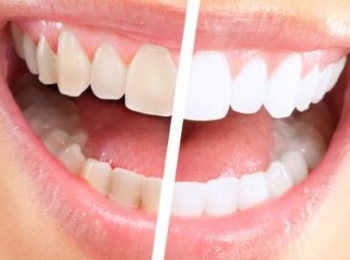 طرق ازالة الجير من الاسنان وتنظيف الاسنان