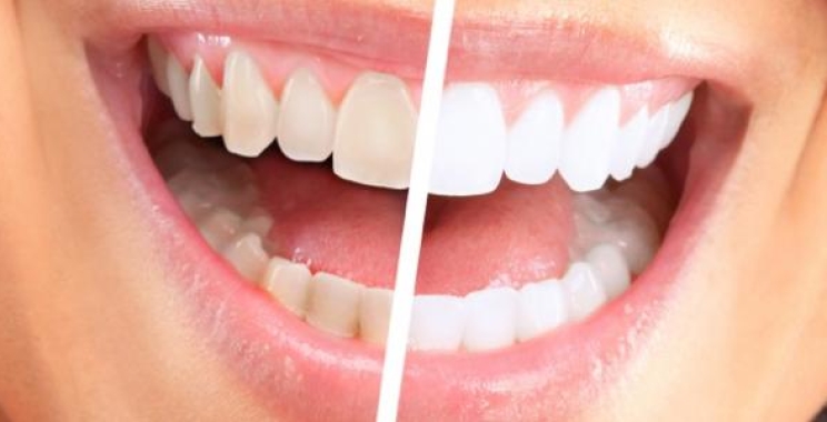 طرق ازالة الجير من الاسنان وتنظيف الاسنان