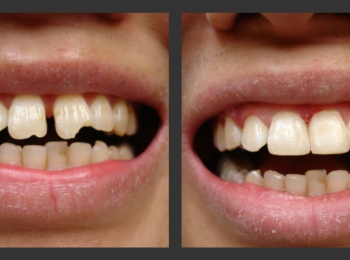 أهم عيوب تجميل الأسنان وكيفية الوقاية منها