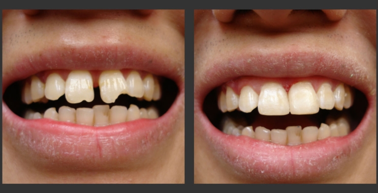 أهم عيوب تجميل الأسنان وكيفية الوقاية منها