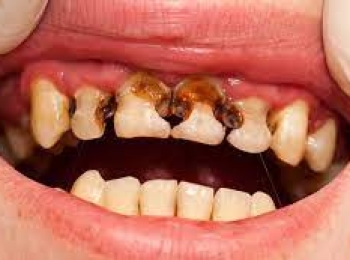 ما هو تسوس الأسنان وكيفية الوقاية منه؟