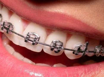 أهم شروط تركيب تقويم الاسنان مع مجمع الطب المتميز