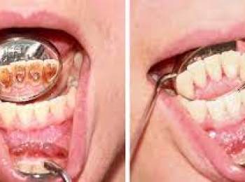 طرق تنظيف اللثة واهم نصائح للمحافظة على صحة الاسنان