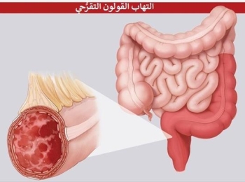 ما هي اهم اعراض التهاب القولون وطرق علاجه؟