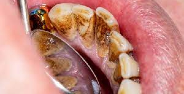 ما هو الجير في الاسنان وماذا يسبب لك؟