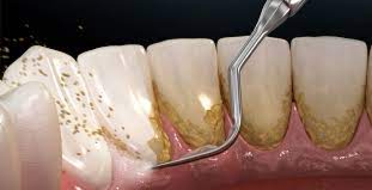 خطوات تنظيف جير الاسنان مع مجمع الطب المتميز