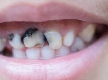 علاج تسوس الأسنان عند الأطفال في المدينة المنورة