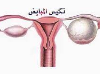 ما هي العلاقة بين التكيسات والحمل