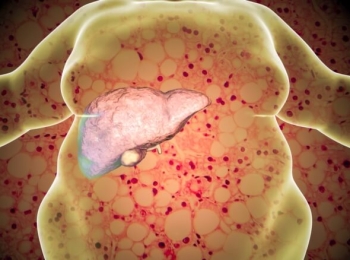 هل الدهون على الكبد خطيرة وماذا تسبب؟