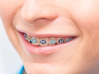 ما هو تقويم اسنان الاطفال وشروطه