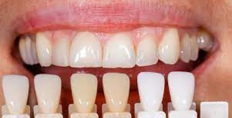 ما هو تجميل الأسنان بالفينير ومميزاته؟