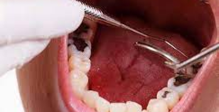 أهم طرق علاج تسوس الاسنان مع افضل اطباء الاسنان في المدينة المنورة