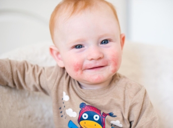 ماذا تعرف عن حساسية الموز للاطفال؟