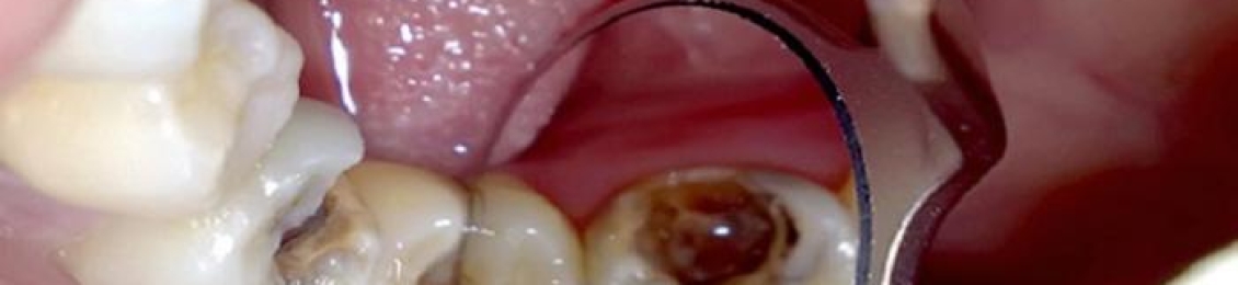 5 اسباب تؤدي إلى التهاب الاسنان تعرف عليها