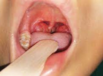 ما هي اسباب التهاب الحلق عند الاطفال؟