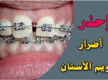 أخطاء تقويم الأسنان الشائعة وكيفية تجنبها