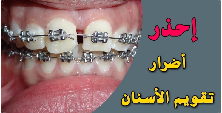 ما هي أضرار تقويم الاسنان للاطفال