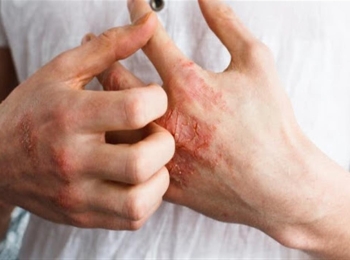 ما هي حساسية البقوليات وأسبابها وطرق العلاج