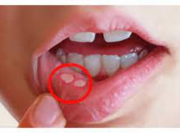 ما هي التهابات اللثة والفم واسبابها؟