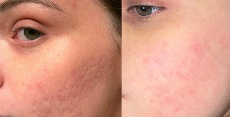 ليزر CO2 لآثار حب الشباب: التجربة الكاملة من الجلسة حتى النتائج