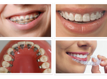 أهمية ومميزات تقويم الأسنان للكبار