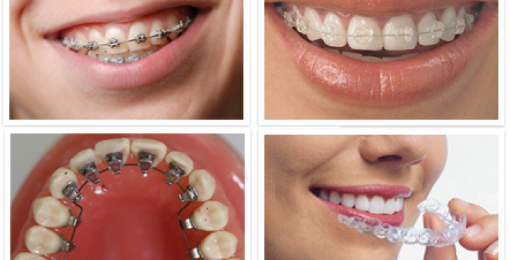 أهمية ومميزات تقويم الأسنان للكبار