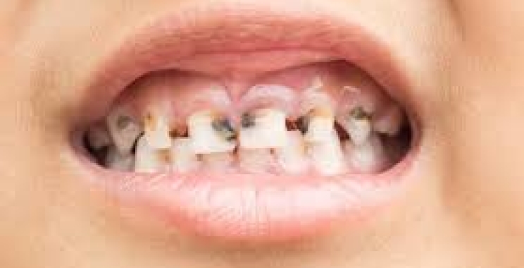 اسباب تسوس الاسنان الاماميه وطرق علاجه