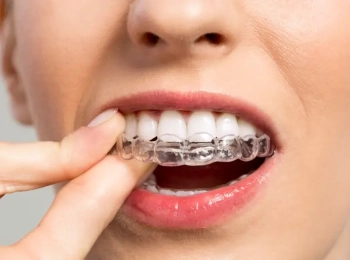 الانفزلاين التقويم الشفاف قبل وبعد