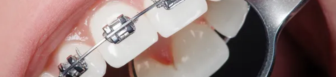 تقويم الاسنان كم مدته وما هي شروط تركيبه؟