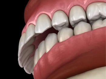افضل طرق تجميل اللثة البارزة في المدينة المنورة