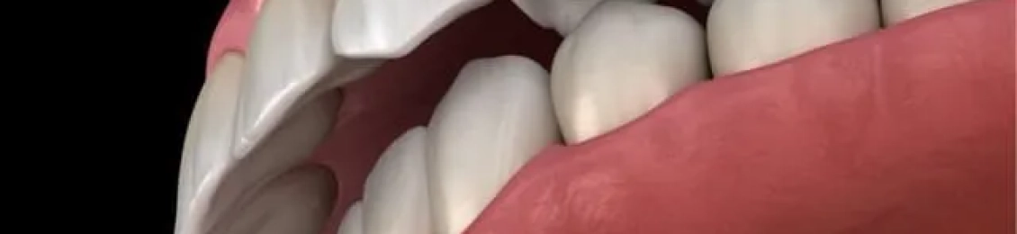 افضل طرق تجميل اللثة البارزة في المدينة المنورة