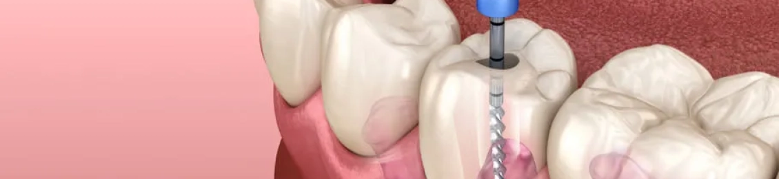 ما هي طريقة حشو العصب الصحيحة مع افضل الاطباء