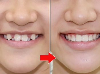 كيف اعرف ان لدي اسنان تحتاج تقويم وافضل الانواع؟