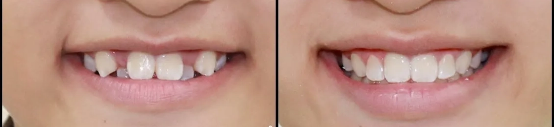 كيف اعرف ان لدي اسنان تحتاج تقويم وافضل الانواع؟