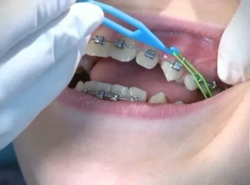 متى يوضع تقويم الأسنان وكيف اختار النوع المناسب؟