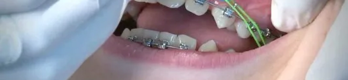 متى يوضع تقويم الأسنان وكيف اختار النوع المناسب؟