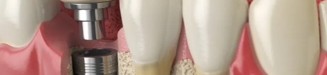 احصل على افضل زراعة ضرس في المدينة المنورة