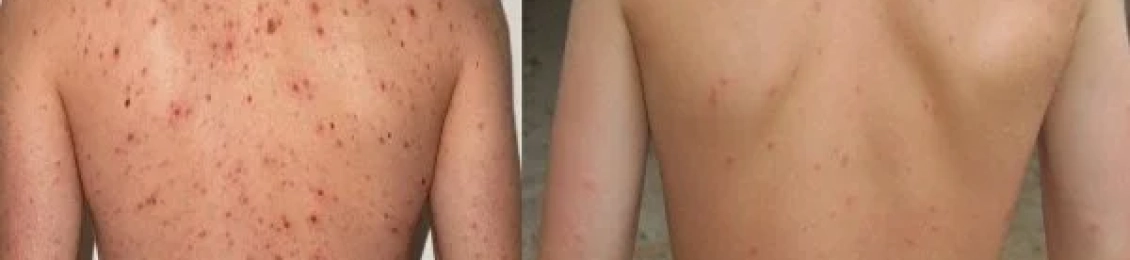 تجربتي مع إزالة آثار الحبوب من الظهر بالليزر ونتائجها