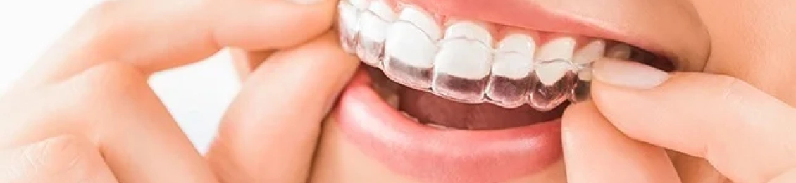 د. ابراهيم زيتوني افضل دكتور تقويم أسنان شفاف 