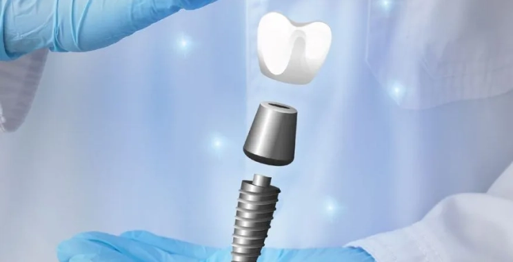 زراعة أسنان في يوم واحد: حقيقة أم مبالغة؟ طبيبك يجيب