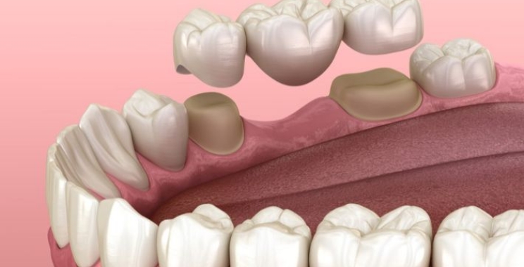 أيهما أفضل زراعة الأسنان أم الجسر؟ مقارنة شاملة للمميزات والعيوب