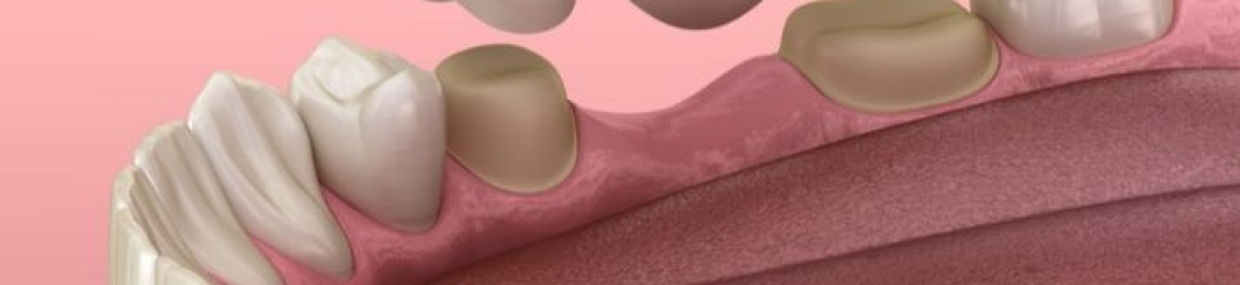 أيهما أفضل زراعة الأسنان أم الجسر؟ مقارنة شاملة للمميزات والعيوب