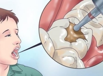 علاج ألم الضرس بعد الحشو الدائم مع أفضل الاطباء