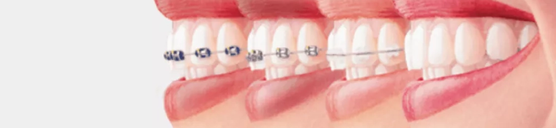 أفضل أنواع تقويم الأسنان واختيار الأنسب لك