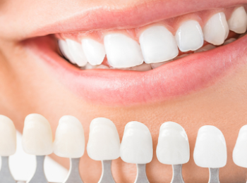 ماهي ابتسامة هوليود وخطوات التركيب والتكلفة المطلوبة من أجل مظهر مثالي للأسنان