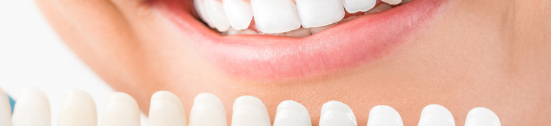 ماهي ابتسامة هوليود وخطوات التركيب والتكلفة المطلوبة من أجل مظهر مثالي للأسنان