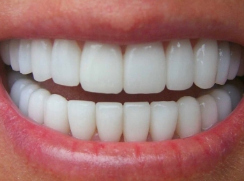 مميزات ابتسامة هوليود المتحركة وأنواع التركيبات التي يمكن استخدامها