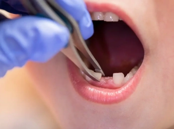 طريقة خلع السن في المنزل ونصائح بعد الخلع